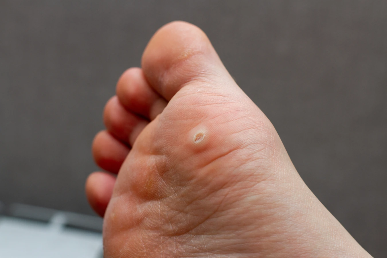 Help 4 skin kurzajki jak stosować?